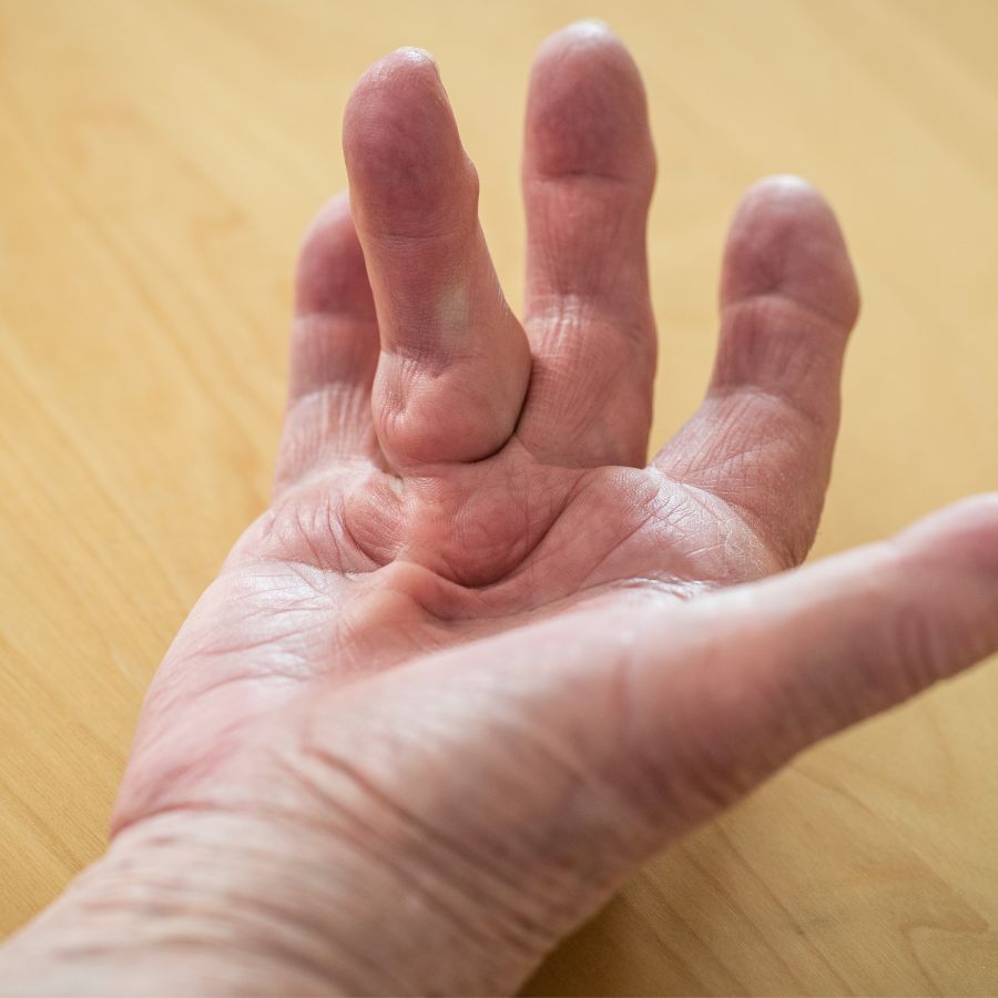 Hand showing symptoms of dupuytren's disease
